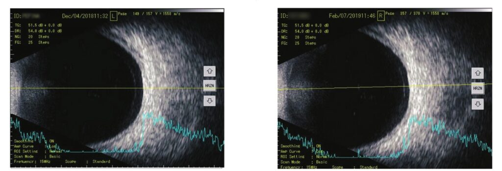 B-scanbeelden van patiënt P. vóór (links) en na (rechts) behandeling met VitroCap®N. Links: dwarse projectie toont een matige hoeveelheid glasvochttroebelingen met 21 pieken met lage amplitude. Rechts: na drie maanden gebruik van VitroCap®N zijn de troebelingen verminderd en resteerden 12 pieken met lage amplitude.