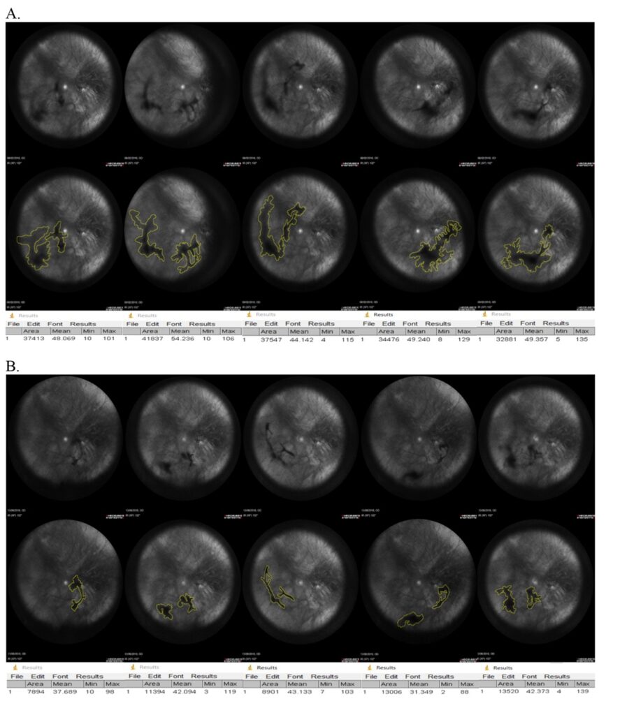 OCT-beelden uit de FLIES-studie van hetzelfde oog. A: bij aanvang van de studie zijn uitgebreide glasvochttroebelingen zichtbaar, handmatig omlijnd in geel. B: na zes maanden behandeling is een duidelijke afname van de troebelingsgebieden te zien, wat een significante verbetering aantoont.