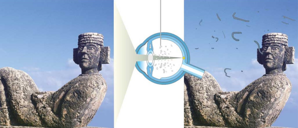 Illustratie van het effect van glasvochttroebelingen (mouches volantes) op het zicht. Links: helder zicht op een stenen beeld. Midden: schematische weergave van het oog met troebelingen in het glasvocht. Rechts: verstoord zicht met donkere slierten en vlekken die het beeld gedeeltelijk blokkeren.